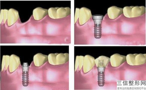 南京僑臺美容第三診所牙齦璧提升術怎樣避免發生后遺癥