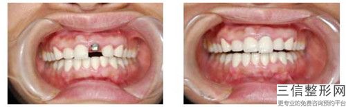 益陽做種植牙會不會影響懷孕