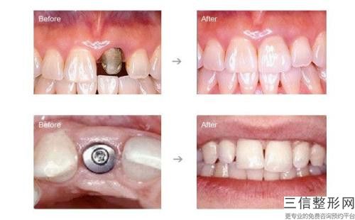 威海人工釉質美牙整形美容適應人群和適應癥