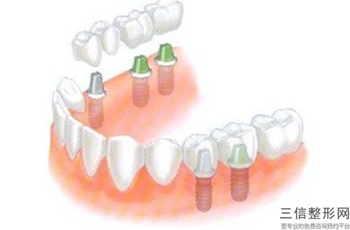 梧州牙齒半冠修復(fù)危險有什么_梧州牙齒半冠修復(fù)整形手術(shù)的有多大風(fēng)險