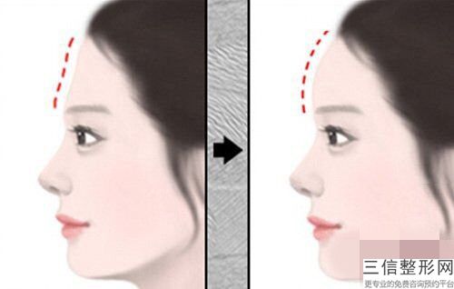 北京伊芙麗格專家工作室價格價位表人氣搶鮮2024-伊維蘭注射額部填充案例