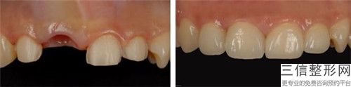 咸陽槽牙牙根外露手術的副作用及效果