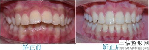 兔牙矯正的術(shù)后效果怎么樣