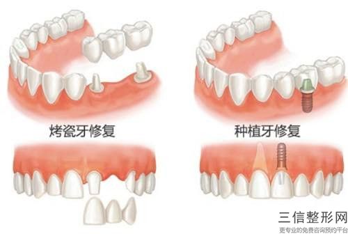 錫林郭勒球帽半固定種植牙術管到什么時候