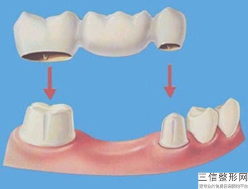 重慶3d氧化鈷全瓷牙手術需要準備多少錢