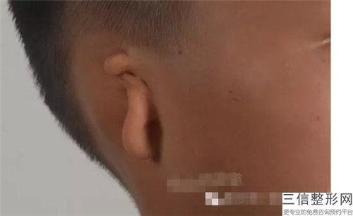 美容醫院人工耳再造推薦：人工耳再造醫院前30全新上線