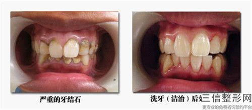 蘇州美國皓得適牙齒美白后遺癥你了解嗎