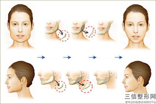 景德鎮市下巴縮短手術價格(2024年景德鎮市下巴縮短手術費用表明細大揭秘)