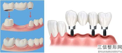 江門牙齒黑三角樹(shù)脂填充手術(shù)費(fèi)用多少