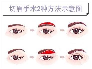 切眉術(shù)多少錢-切眉術(shù)整形價格