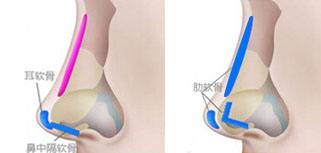 肋軟骨隆鼻多少錢_肋軟骨隆鼻整形手術價格