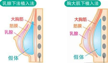 假體隆胸多少錢_假體隆胸整形手術價格