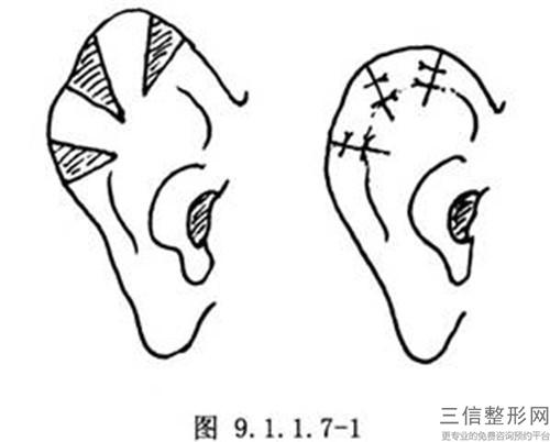 矯正不良耳部形態的費用_進行一次矯正耳畸形大約多少錢呢？