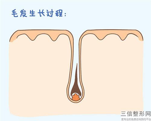 當前火爆的激光去毛法的價位介紹