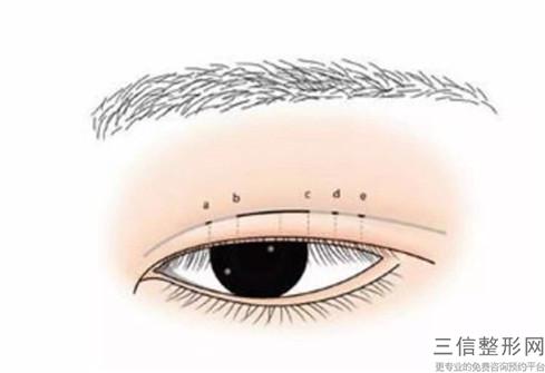 內(nèi)眥開大術(shù)和外眥開大整形術(shù)分別花多少錢