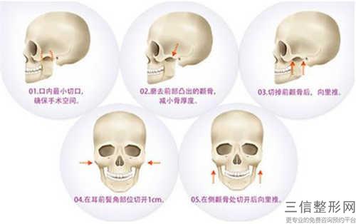 下頜角整形合適什么樣的臉部形狀