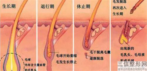 FUE移植頭發可以讓愛美者變年青嗎